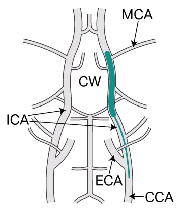 Ischemic stroke graphic